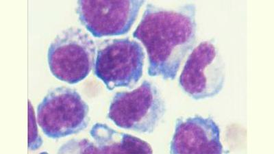 genetically-engineered-bone-marrow-cells-slow-growth-of-prostate-and-pancreatic-cancer-cells-in-mice